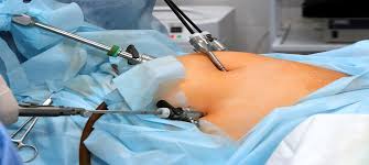 Bariatric Surgery