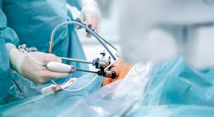 Cholecystectomy