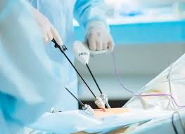 Cholecystectomy