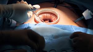 Colectomy