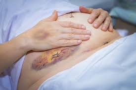 Endometriosis Surgery