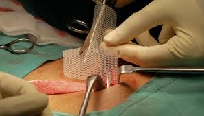 Hernia Repair