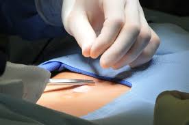 Cholecystectomy