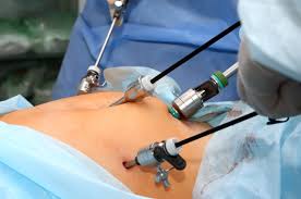 Cholecystectomy