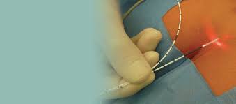 Cholecystectomy