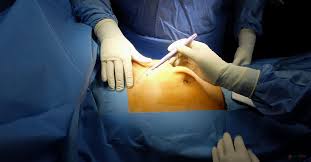 Cholecystectomy