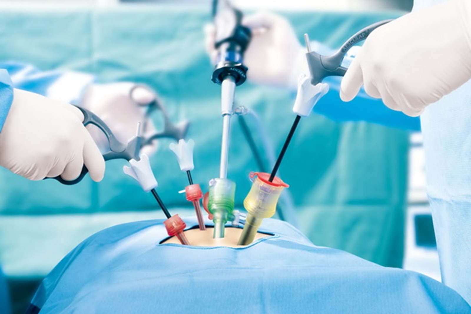 Cholecystectomy