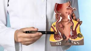 Cholecystectomy