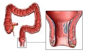 Cholecystectomy