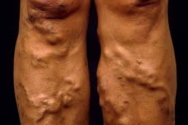Cholecystectomy